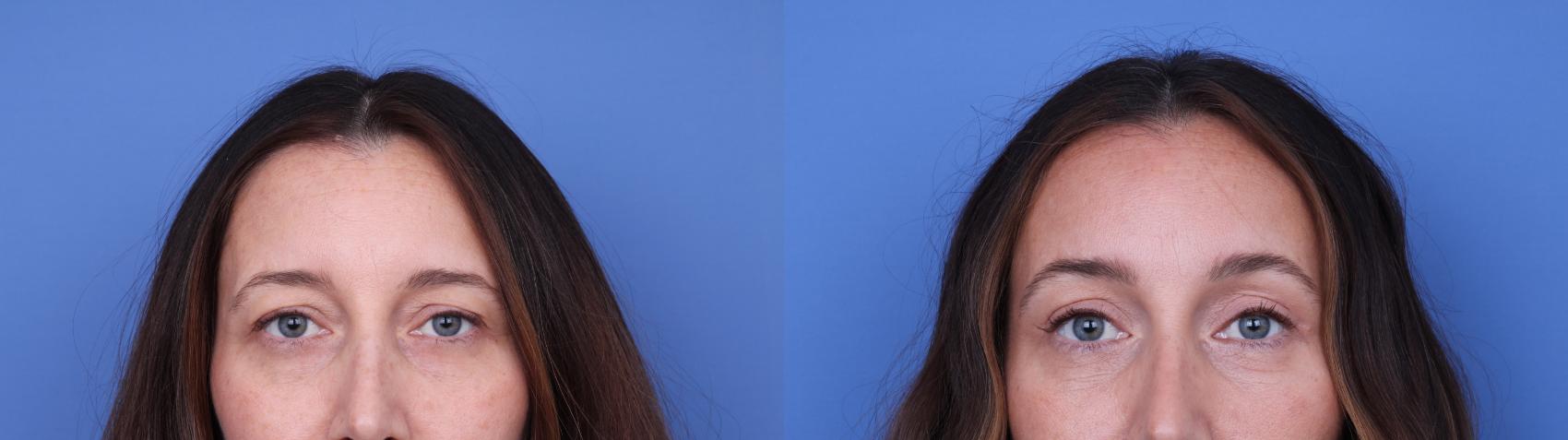 Before & After Brow Lift Case 737 Zoom Blepharoplasty View in Scottsdale, AZ