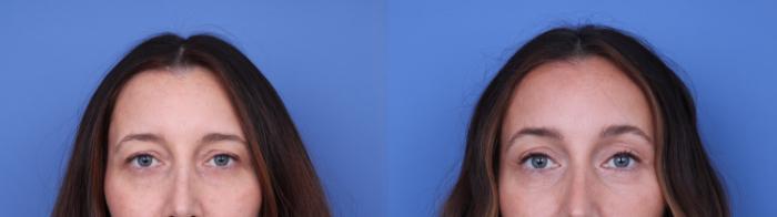 Before & After Brow Lift Case 737 Zoom Blepharoplasty View in Scottsdale, AZ