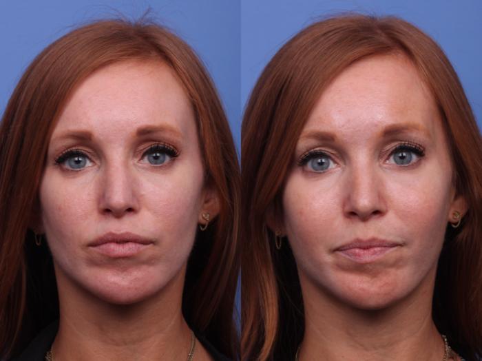 Cheek Implant Before & After Photo | Scottsdale, AZ | Hobgood Facial Plastic Surgery: Todd Hobgood, MD
