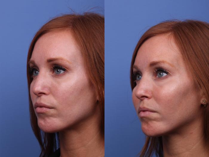 Cheek Implant Before & After Photo | Scottsdale, AZ | Hobgood Facial Plastic Surgery: Todd Hobgood, MD