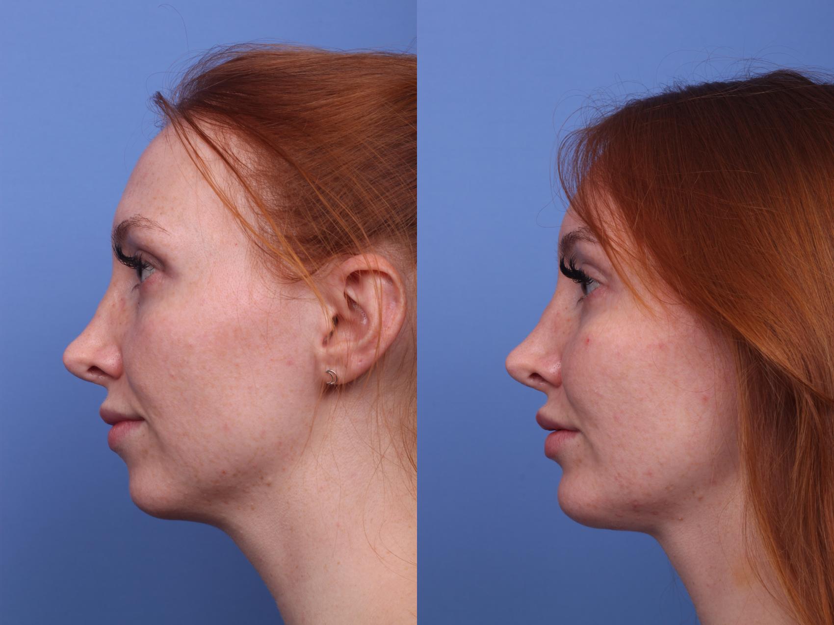 Chin Implant Before & After Photo | Scottsdale, AZ | Hobgood Facial Plastic Surgery: Todd Hobgood, MD