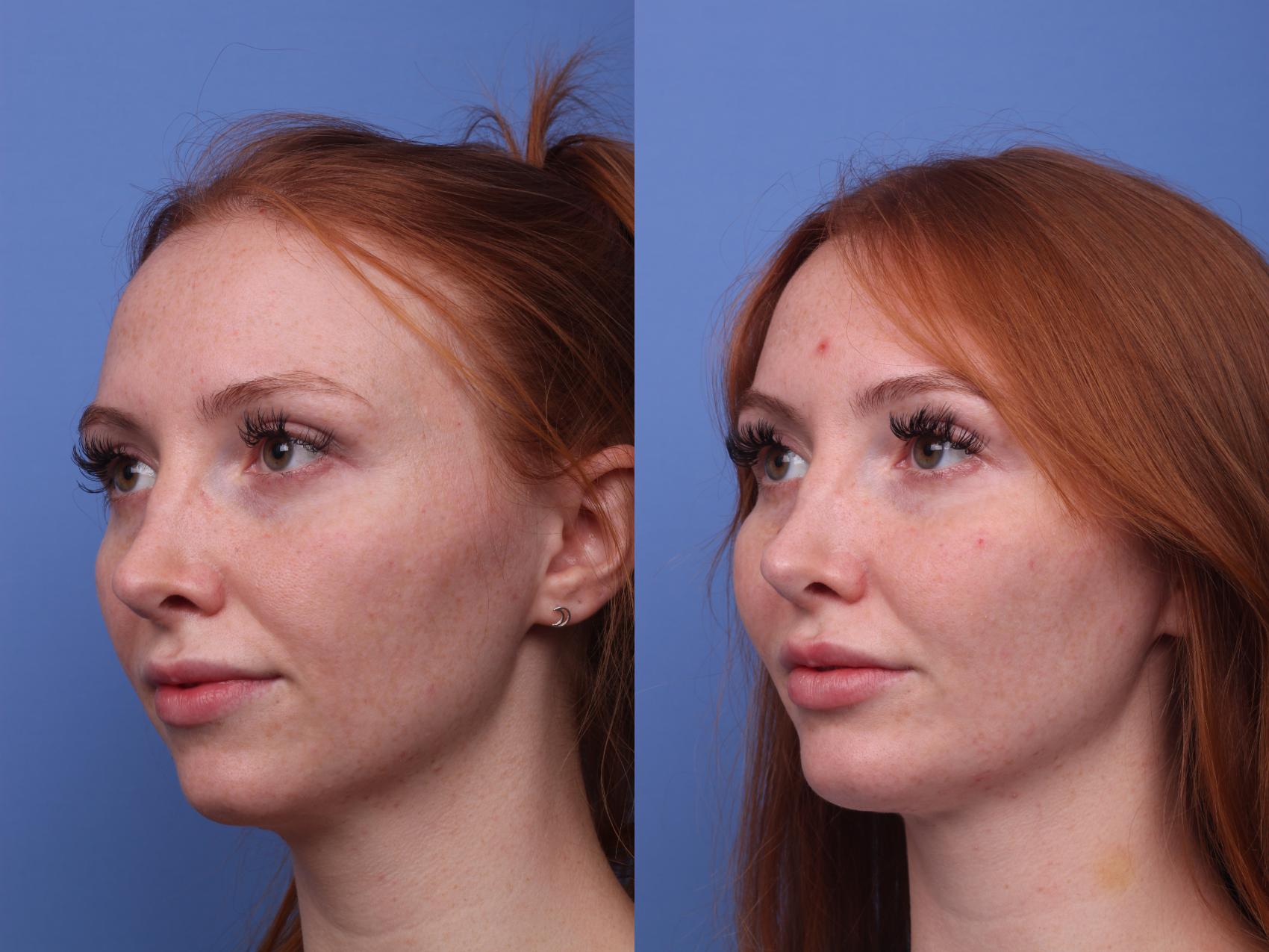 Before & After Chin Implant Case 263 View #2 View in Scottsdale, AZ