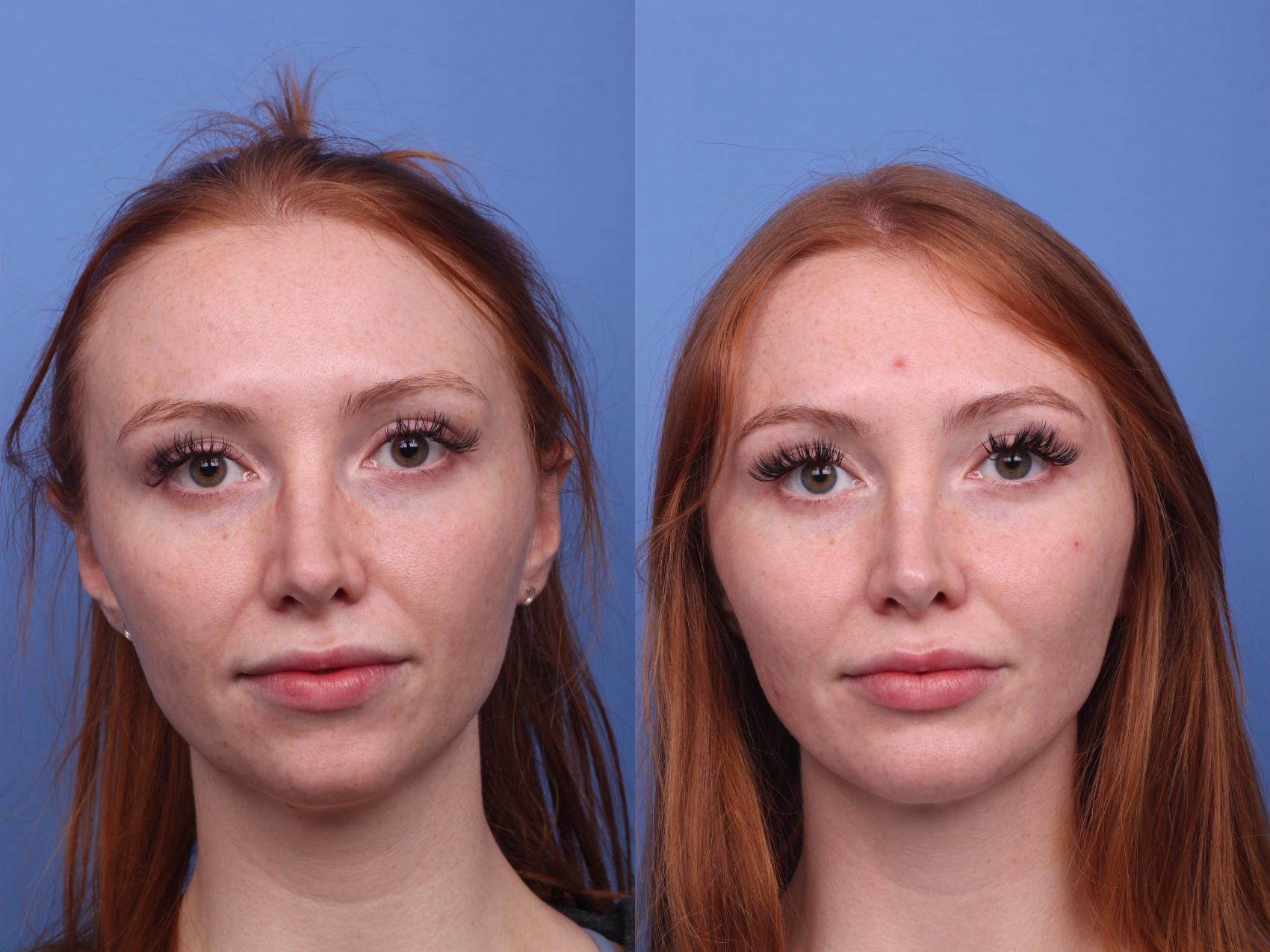 Before & After Chin Implant Case 263 View #3 View in Scottsdale, AZ