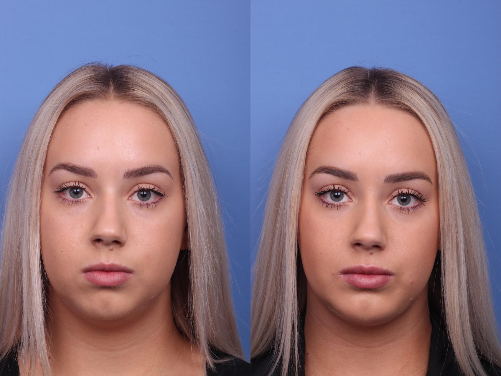 Chin Implant Before And After Photo Gallery Scottsdale AZ Hobgood 