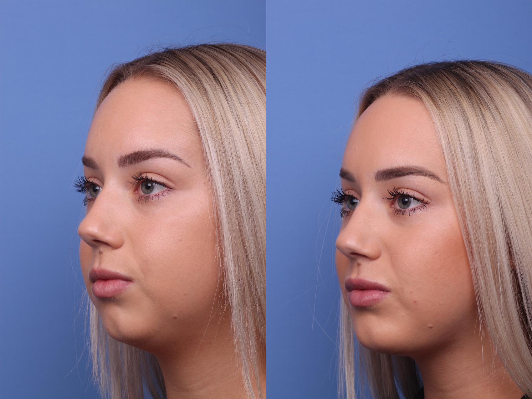 Before & After Chin Implant Case 270 View #3 View in Scottsdale, AZ