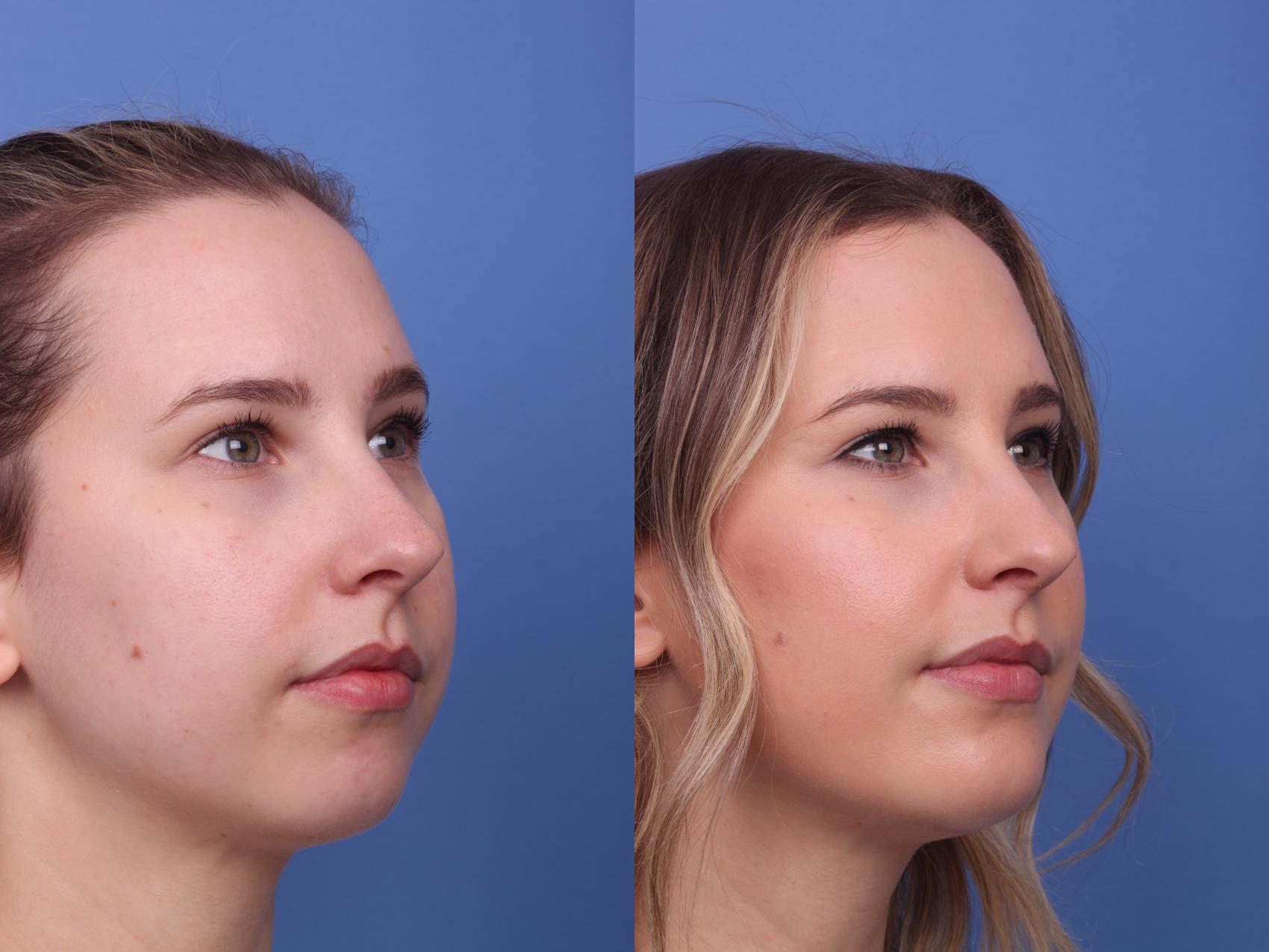 Before & After Chin Implant Case 282 View #3 View in Scottsdale, AZ