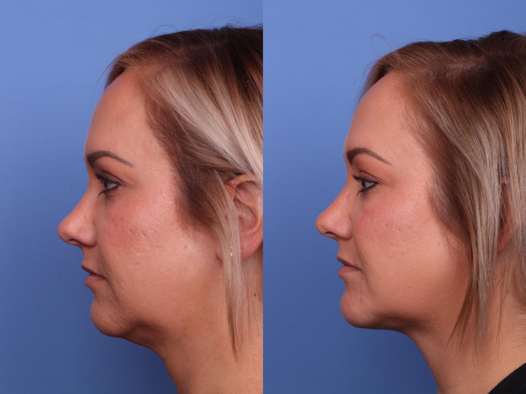 Before & After Submental Liposuction Case 533 Left Side View in Scottsdale, AZ