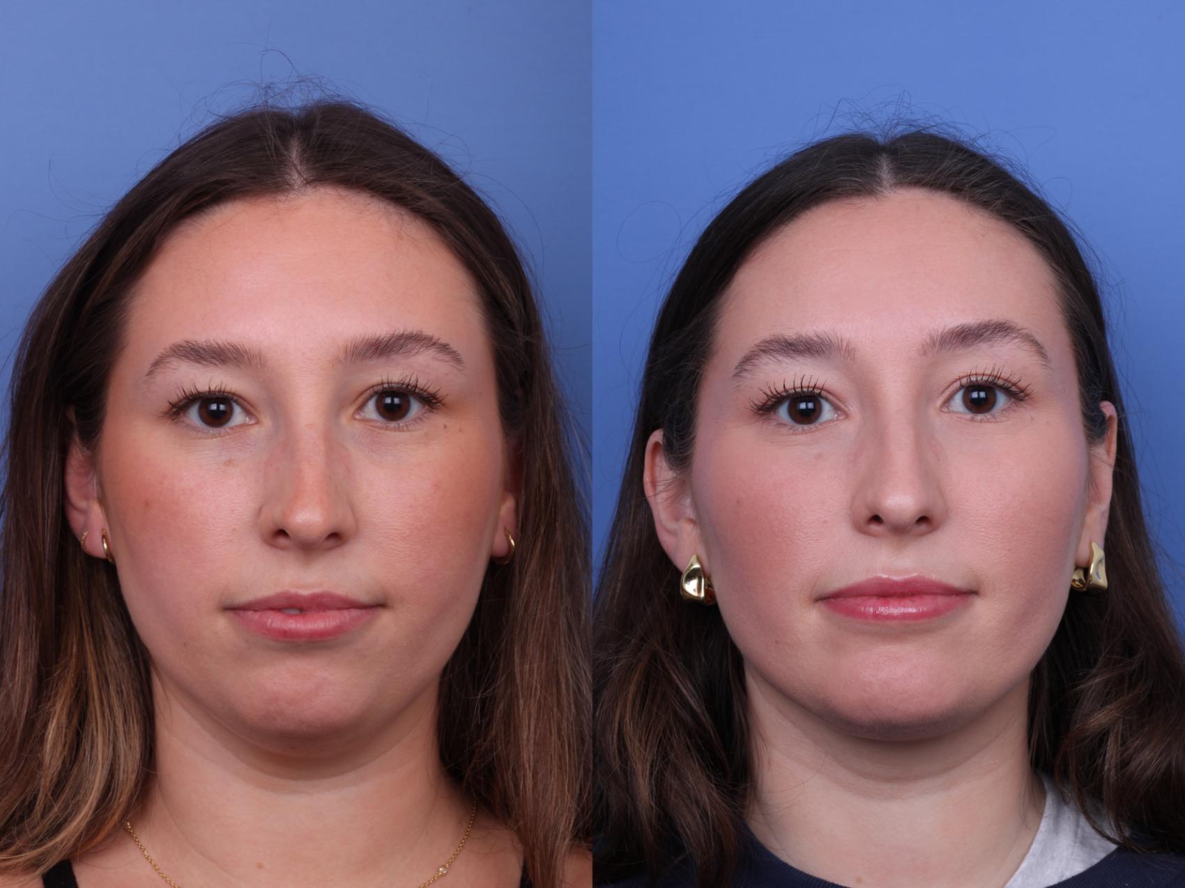 Before & After Chin Implant Case 636 Front View in Scottsdale, AZ