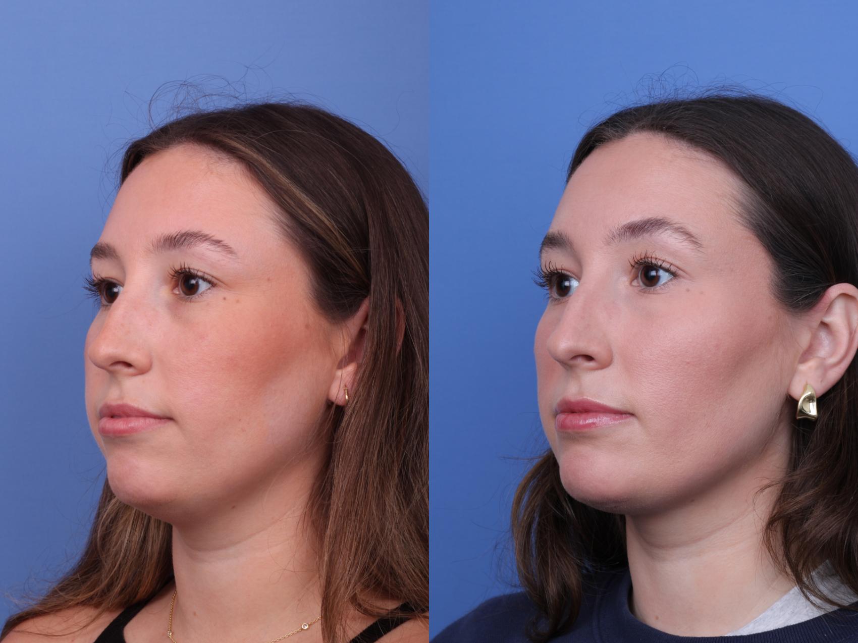 Before & After Chin Implant Case 636 Left Oblique View in Scottsdale, AZ