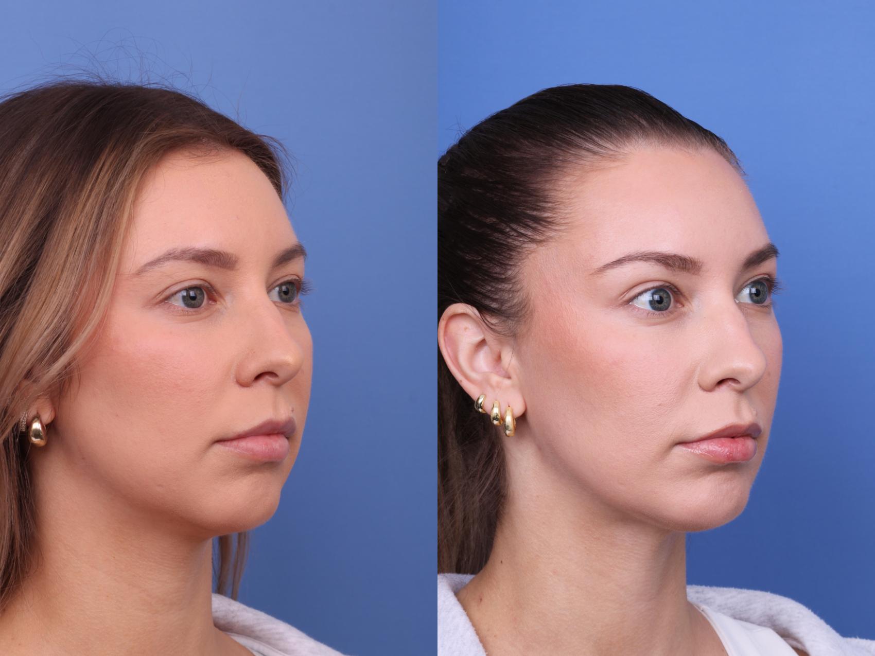 Before & After Chin Implant Case 637 Right Oblique View in Scottsdale, AZ
