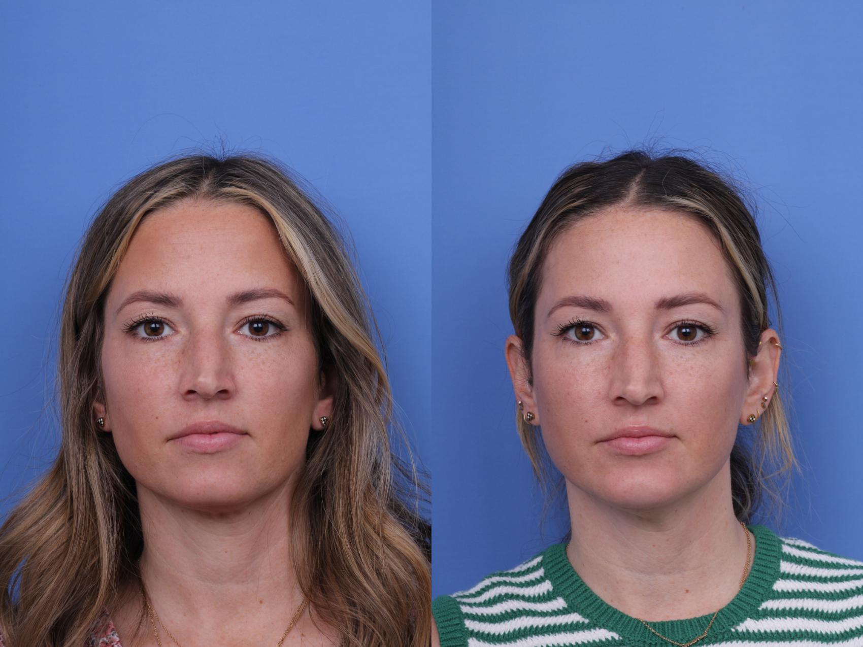 Before & After Chin Implant Case 735 Front View in Scottsdale, AZ