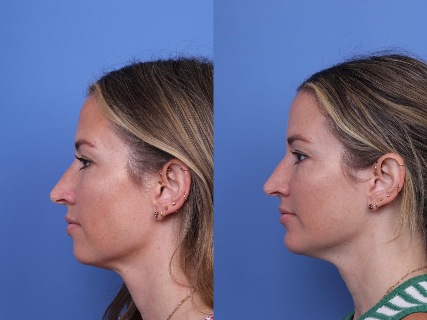 Before & After Chin Implant Case 735 Left Side View in Scottsdale, AZ