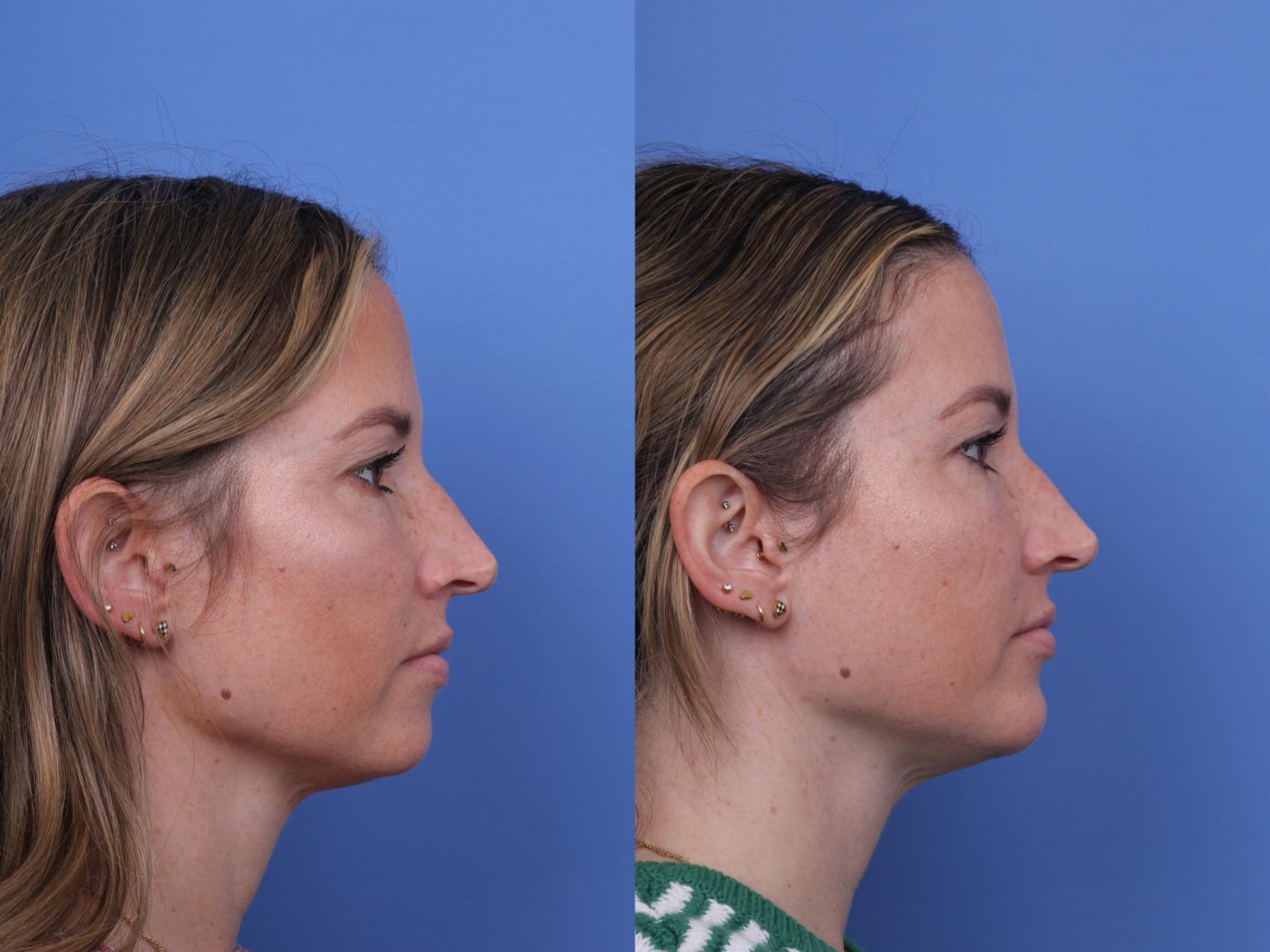 Before & After Chin Implant Case 735 Right Side View in Scottsdale, AZ