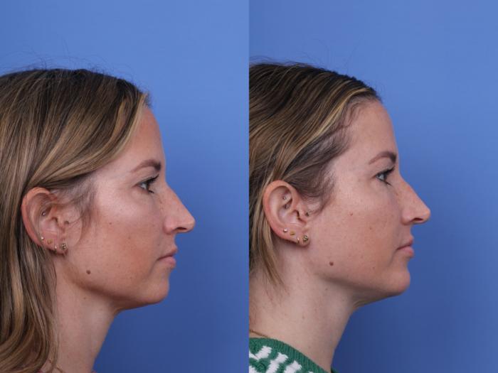 Before & After Chin Implant Case 735 Right Side View in Scottsdale, AZ
