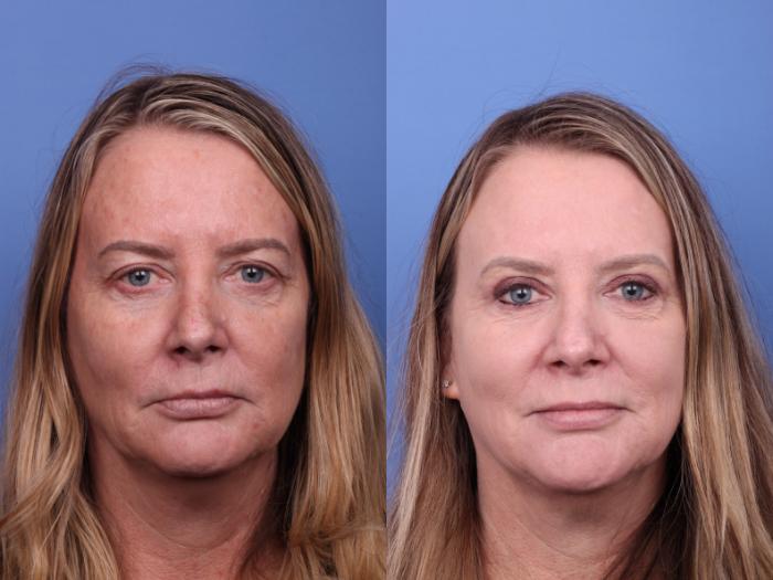 CO2 Laser Resurfacing (under anesthesia) Before & After Photo | Scottsdale & Phoenix, AZ | Hobgood Facial Plastic Surgery: Todd Hobgood, MD