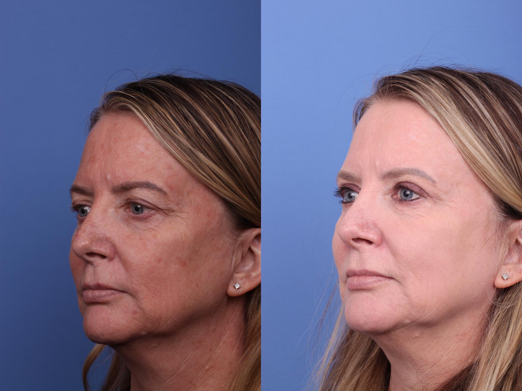Before & After CO2 Laser Resurfacing (under anesthesia) Case 538 Left Oblique View in Scottsdale, AZ