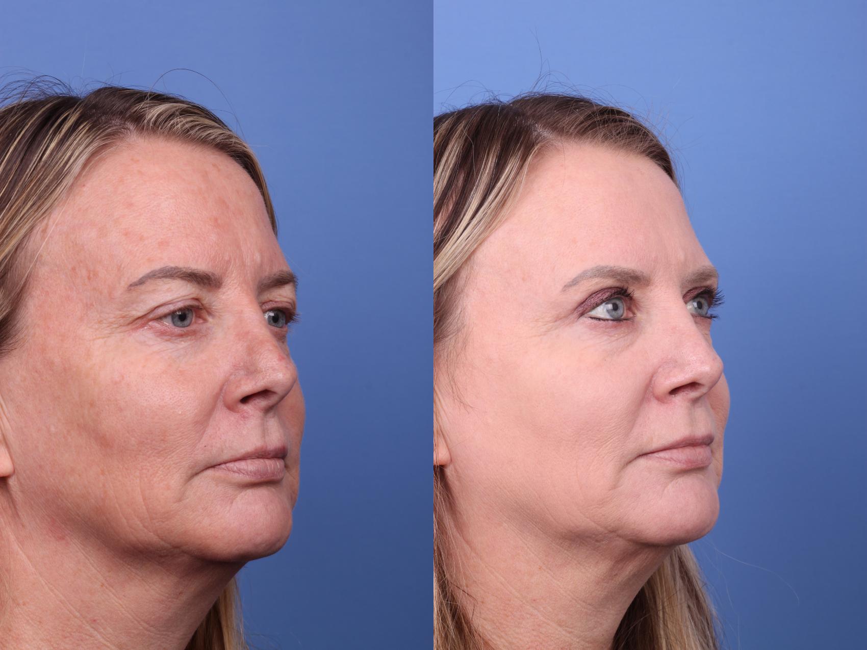 CO2 Laser Resurfacing (under anesthesia) Before and After Pictures Case ...