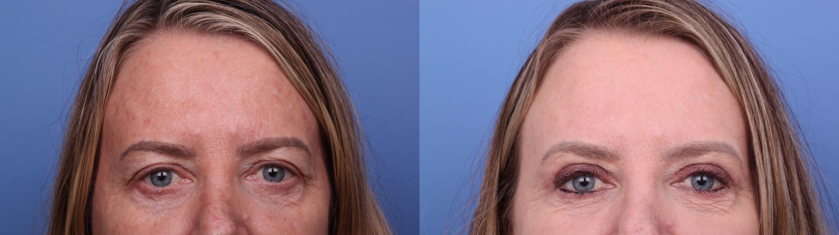 Before & After CO2 Laser Resurfacing (under anesthesia) Case 538 Zoom Bleph View in Scottsdale, AZ