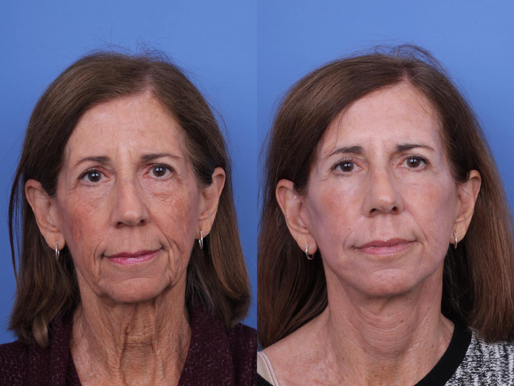 Before & After CO2 Laser Resurfacing (under anesthesia) Case 717 Front View in Scottsdale, AZ