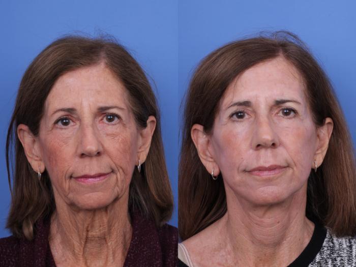 Before & After CO2 Laser Resurfacing (under anesthesia) Case 717 Front View in Scottsdale, AZ