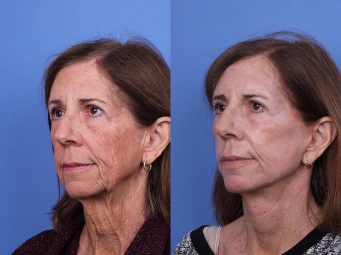 Before & After CO2 Laser Resurfacing (under anesthesia) Case 717 Left Oblique View in Scottsdale, AZ