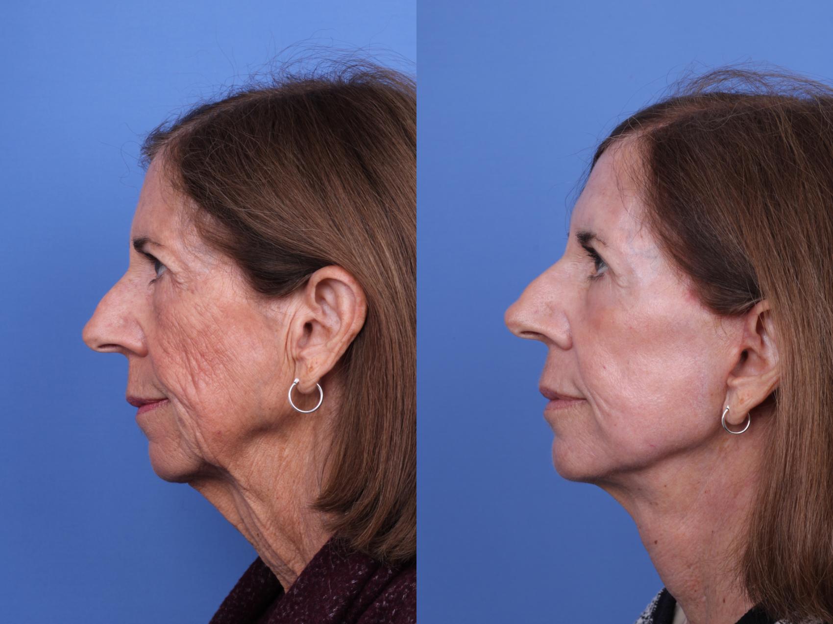 Before & After CO2 Laser Resurfacing (under anesthesia) Case 717 Left Side View in Scottsdale, AZ