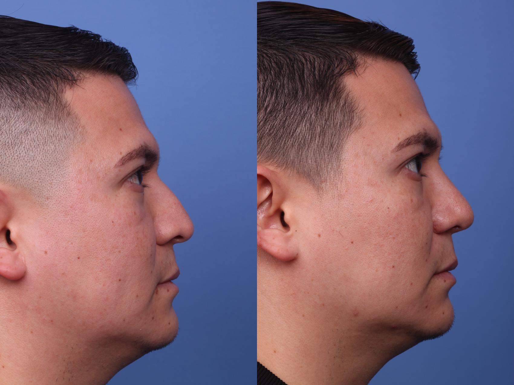 Ethnic Rhinoplasty Before & After Photo | Scottsdale & Phoenix, AZ | Hobgood Facial Plastic Surgery: Todd Hobgood, MD