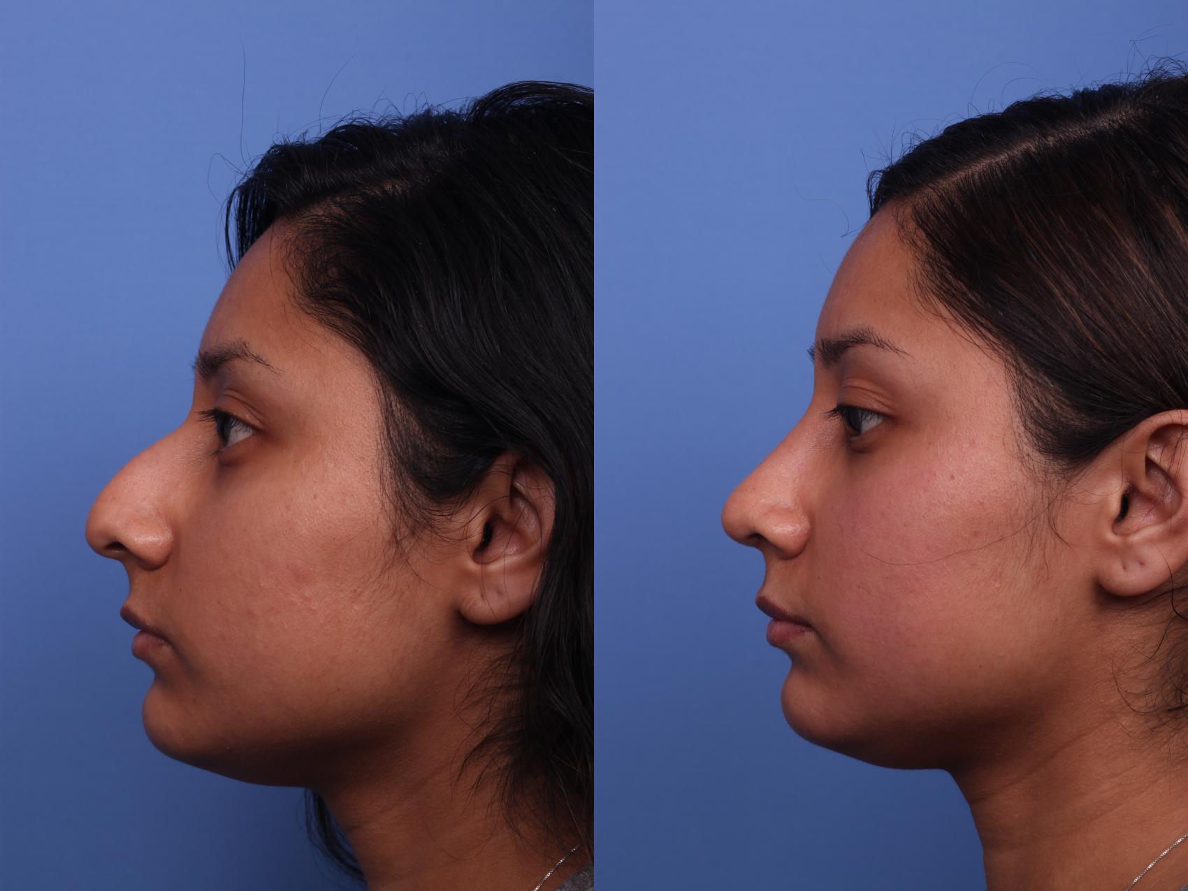 Ethnic Rhinoplasty Before & After Photo | Scottsdale & Phoenix, AZ | Hobgood Facial Plastic Surgery: Todd Hobgood, MD