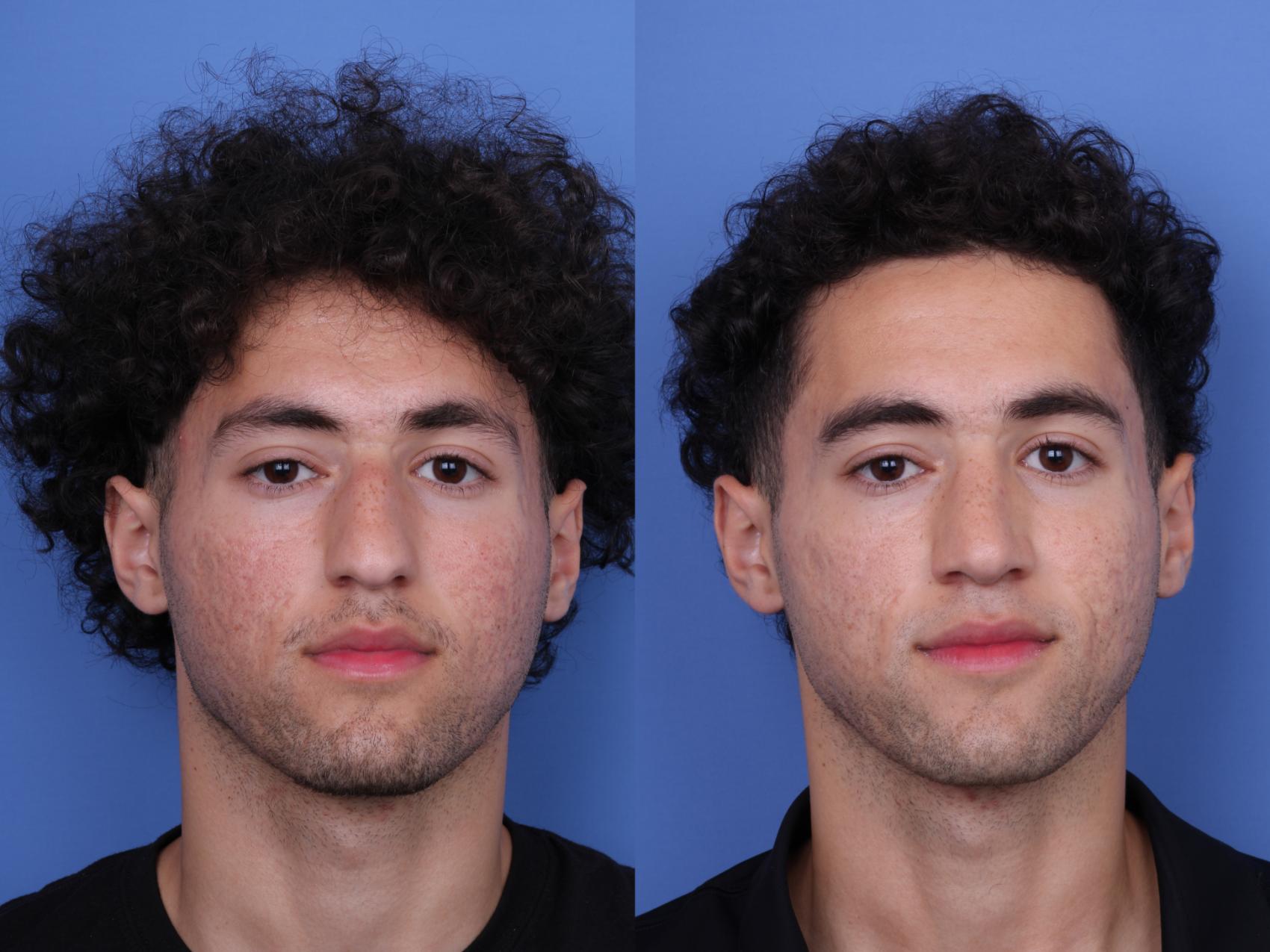 Before & After Ethnic Rhinoplasty Case 682 Front View in Scottsdale, AZ