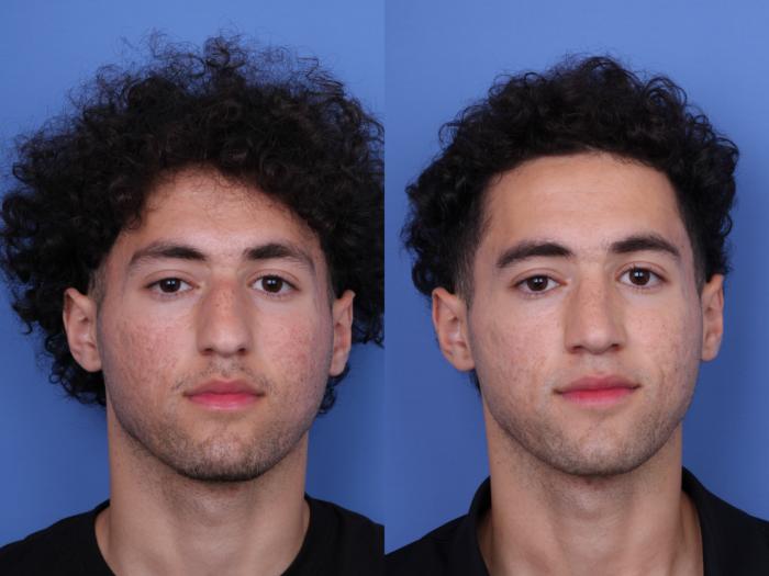 Before & After Ethnic Rhinoplasty Case 682 Front View in Scottsdale, AZ