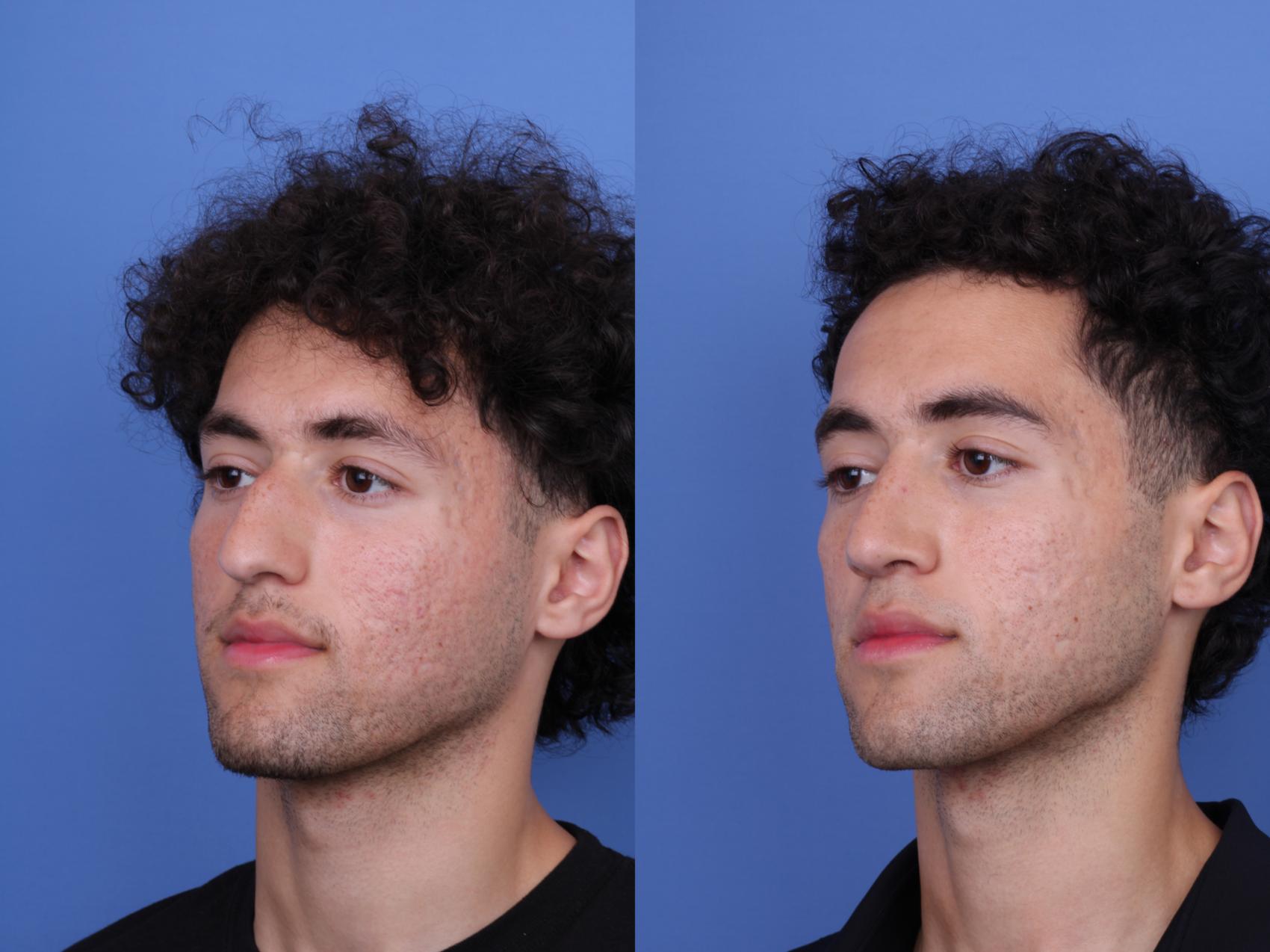 Before & After Ethnic Rhinoplasty Case 682 Left Oblique View in Scottsdale, AZ