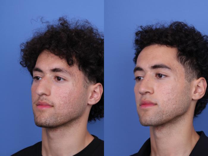 Before & After Ethnic Rhinoplasty Case 682 Left Oblique View in Scottsdale, AZ