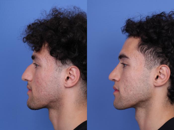 Before & After Ethnic Rhinoplasty Case 682 Left Side View in Scottsdale, AZ