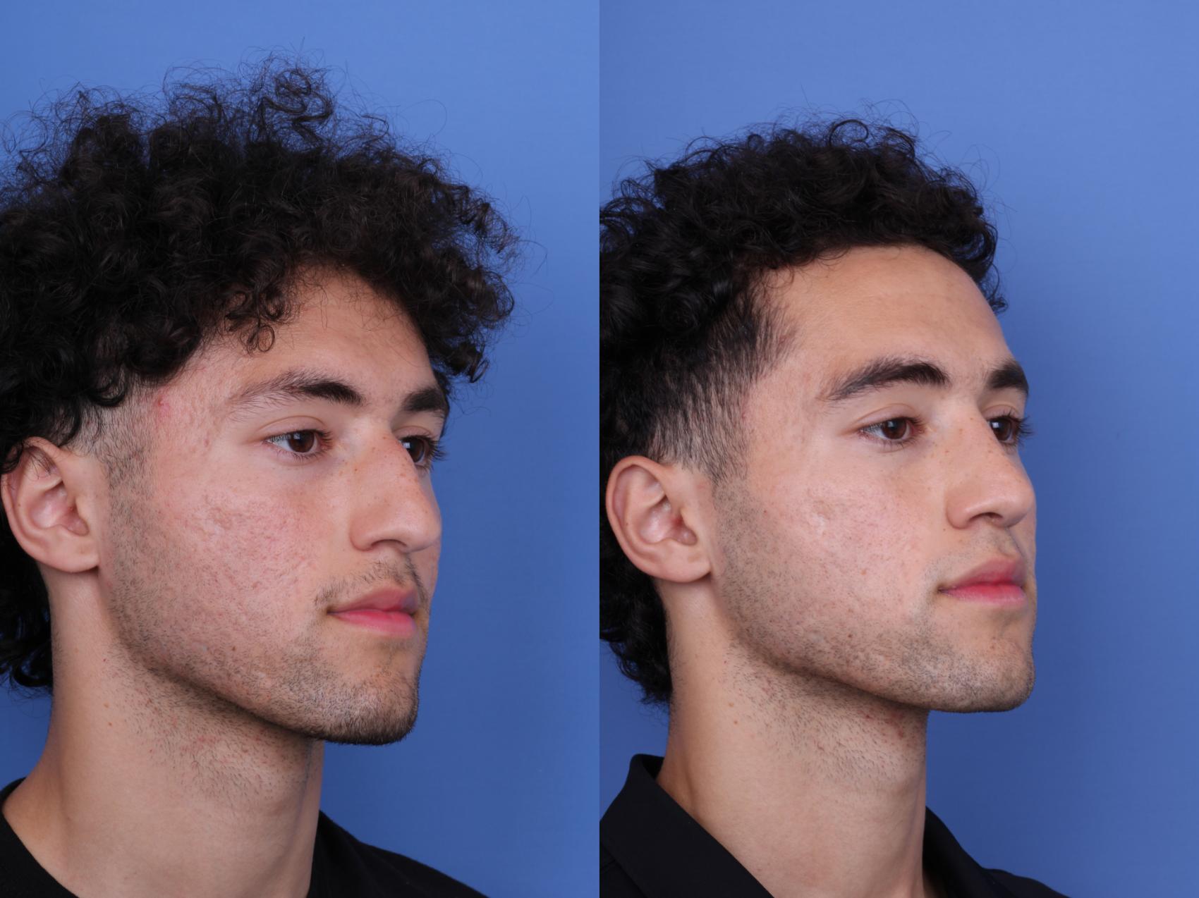 Before & After Ethnic Rhinoplasty Case 682 Right Oblique View in Scottsdale, AZ