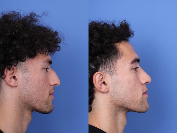 Before & After Ethnic Rhinoplasty Case 682 Right Side View in Scottsdale, AZ