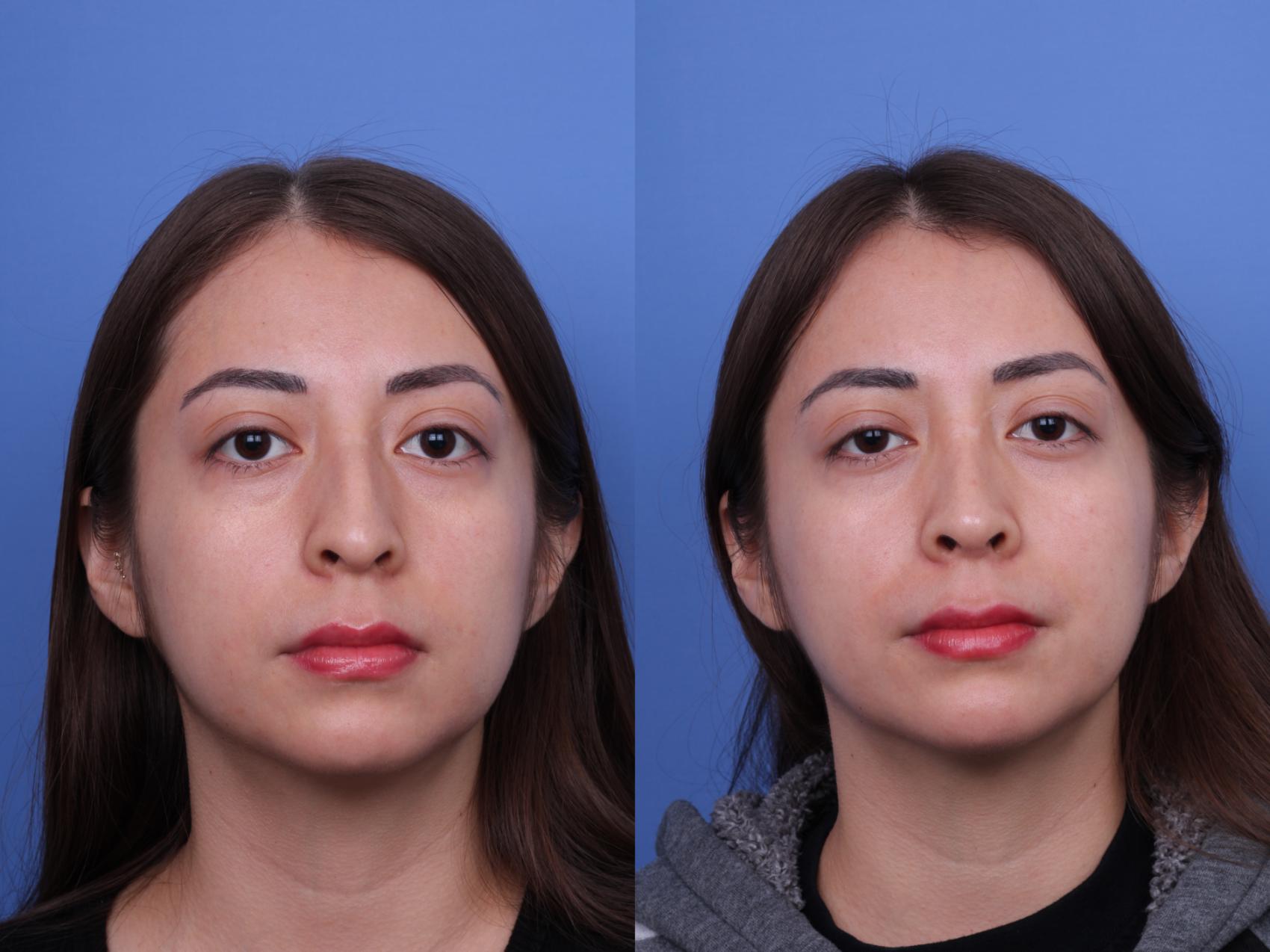 Before & After Ethnic Rhinoplasty Case 691 Front View in Scottsdale, AZ