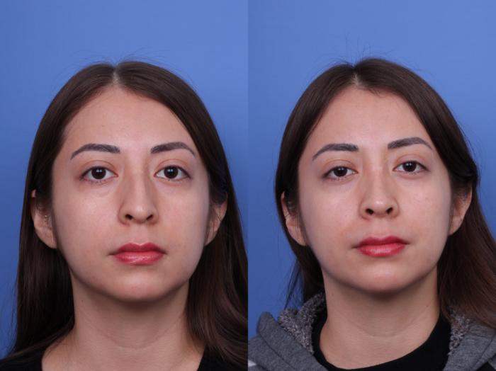 Before & After Ethnic Rhinoplasty Case 691 Front View in Scottsdale, AZ