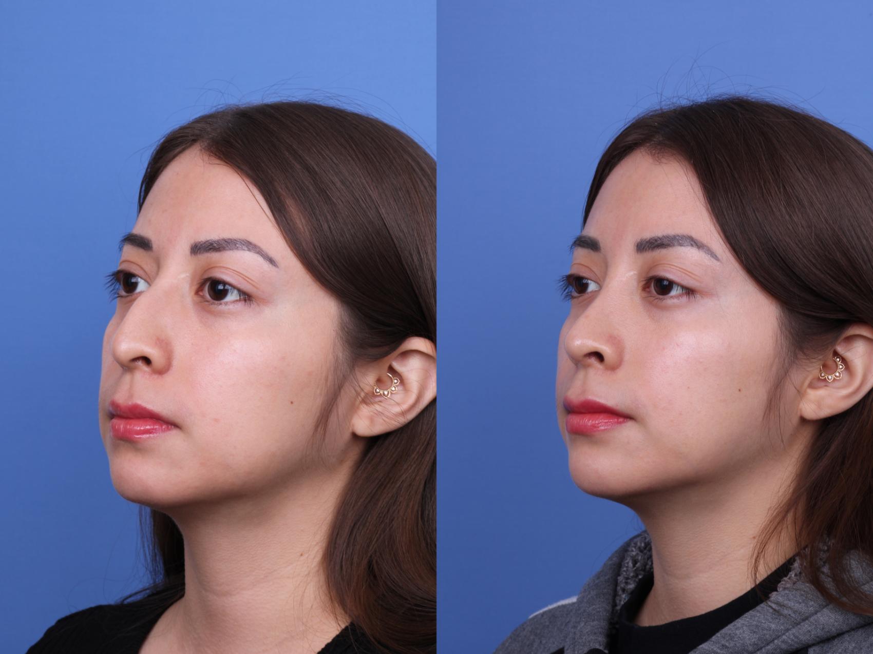 Before & After Ethnic Rhinoplasty Case 691 Left Oblique View in Scottsdale, AZ