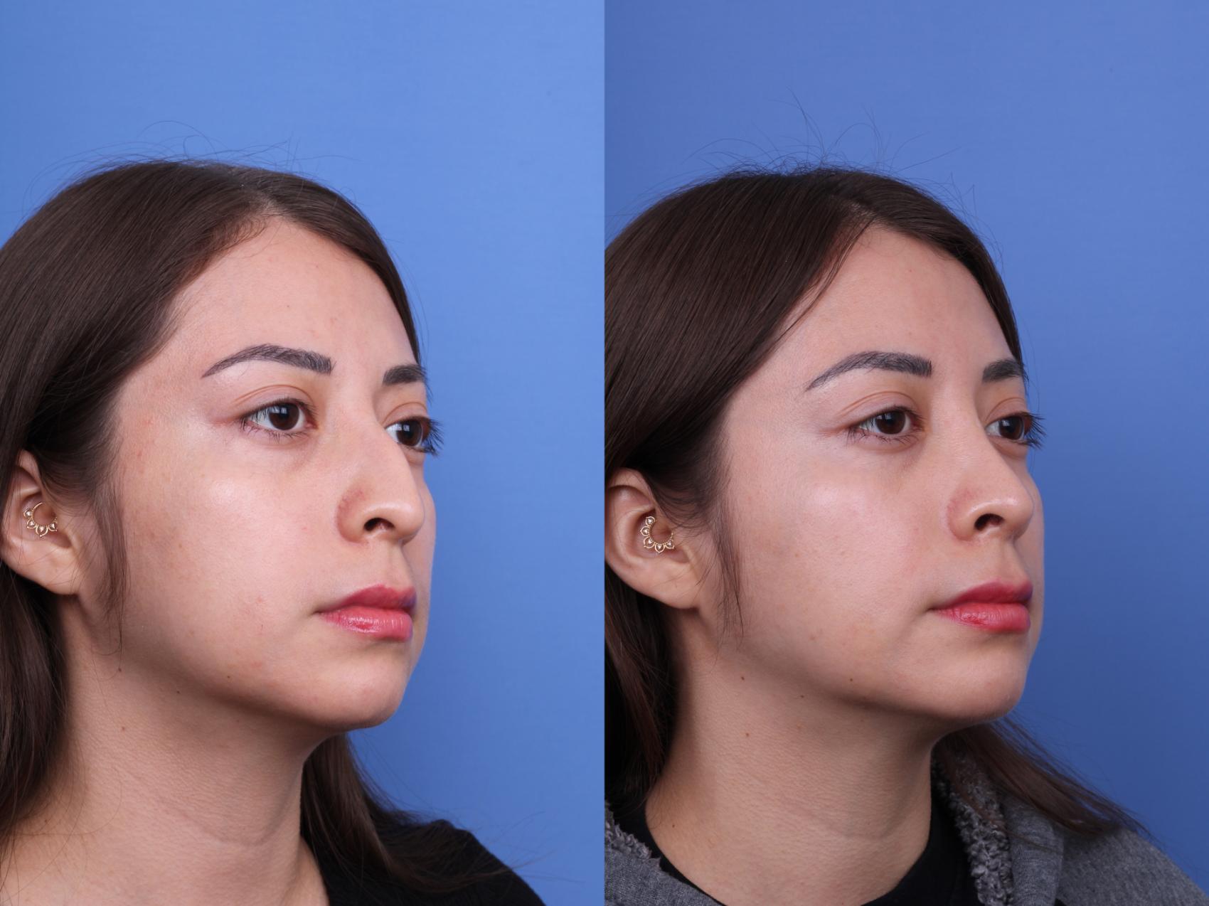 Before & After Ethnic Rhinoplasty Case 691 Right Oblique View in Scottsdale, AZ