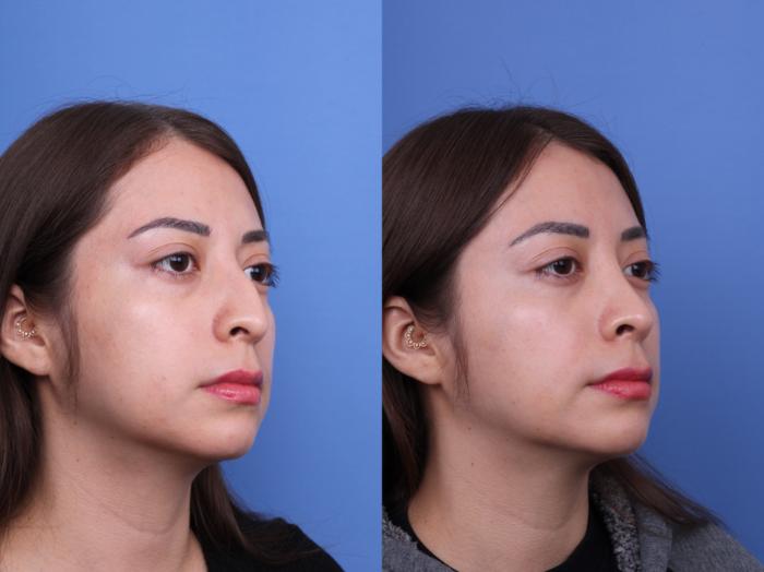Before & After Ethnic Rhinoplasty Case 691 Right Oblique View in Scottsdale, AZ