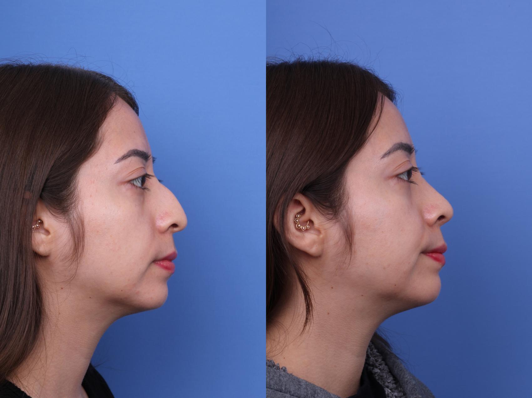 Before & After Ethnic Rhinoplasty Case 691 Right Side View in Scottsdale, AZ
