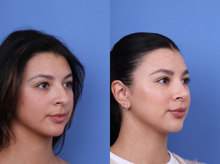 Before & After Ethnic Rhinoplasty Case 694 Right Oblique View in Scottsdale, AZ