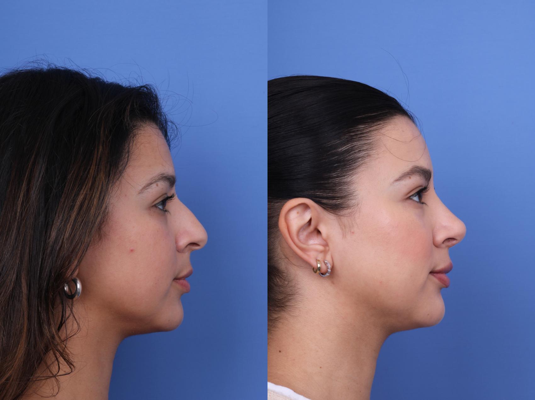 Before & After Ethnic Rhinoplasty Case 694 Right Side View in Scottsdale, AZ