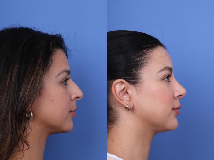 Before & After Ethnic Rhinoplasty Case 694 Right Side View in Scottsdale, AZ