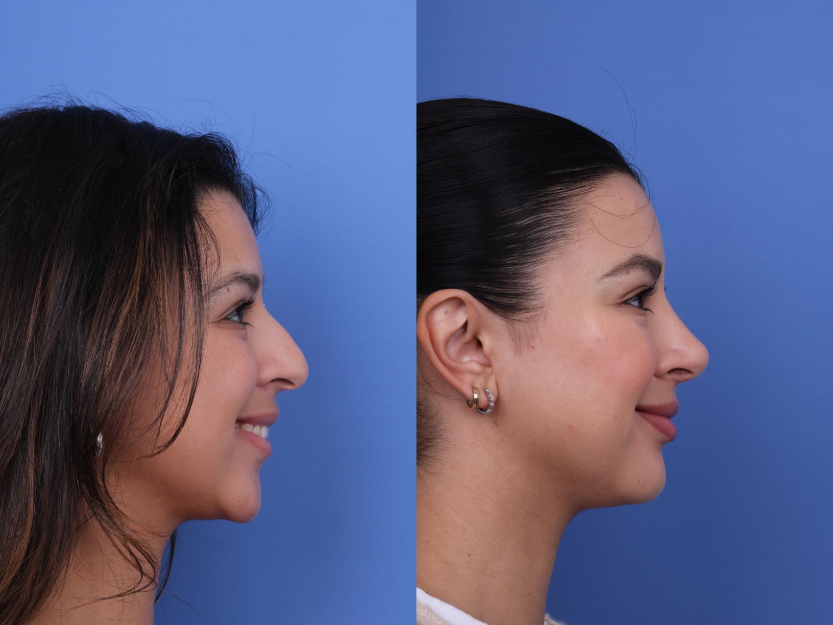 Before & After Ethnic Rhinoplasty Case 694 Right Smile View in Scottsdale, AZ