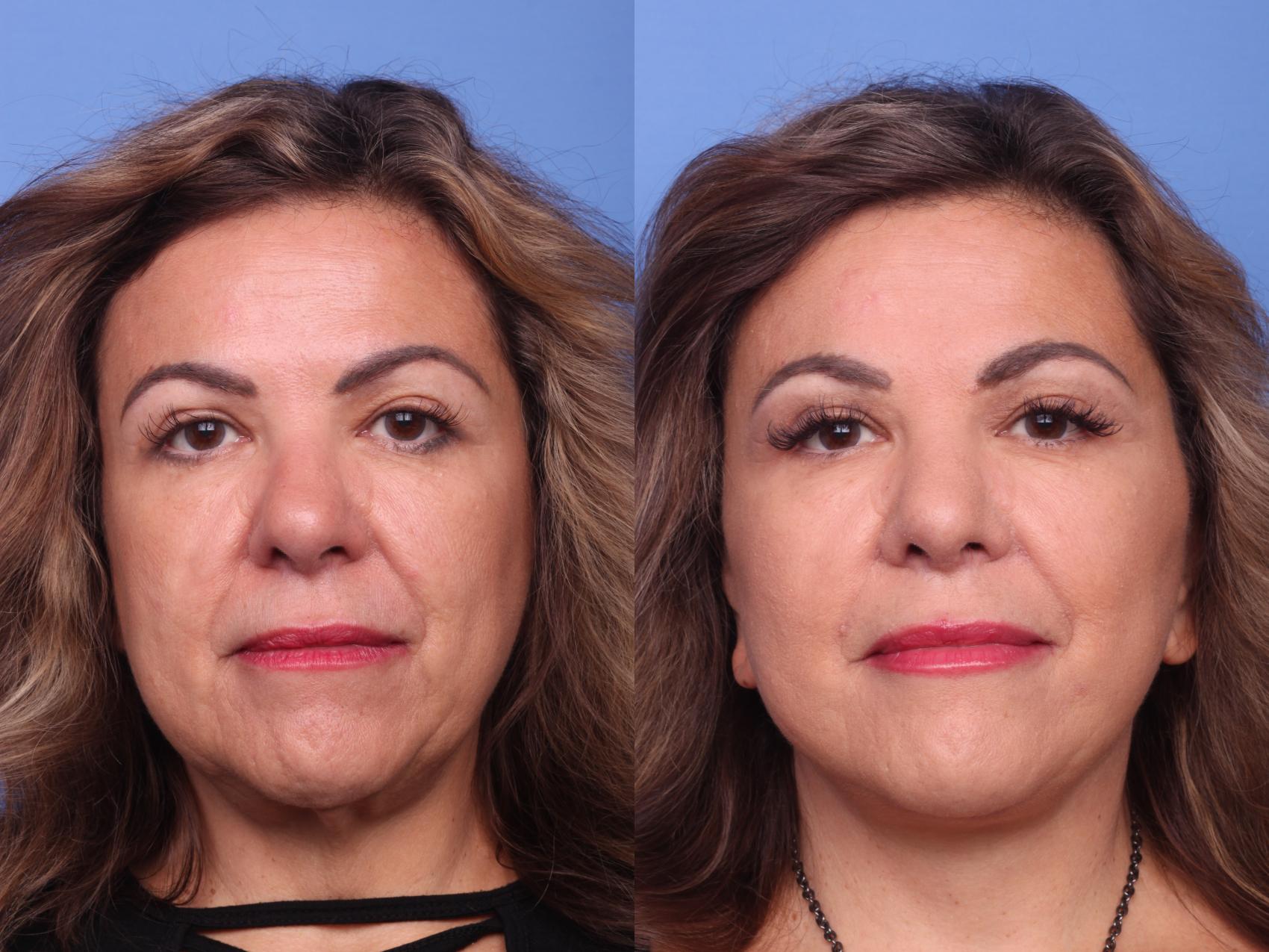 Before & After Facelift Case 149 View #1 View in Scottsdale, AZ