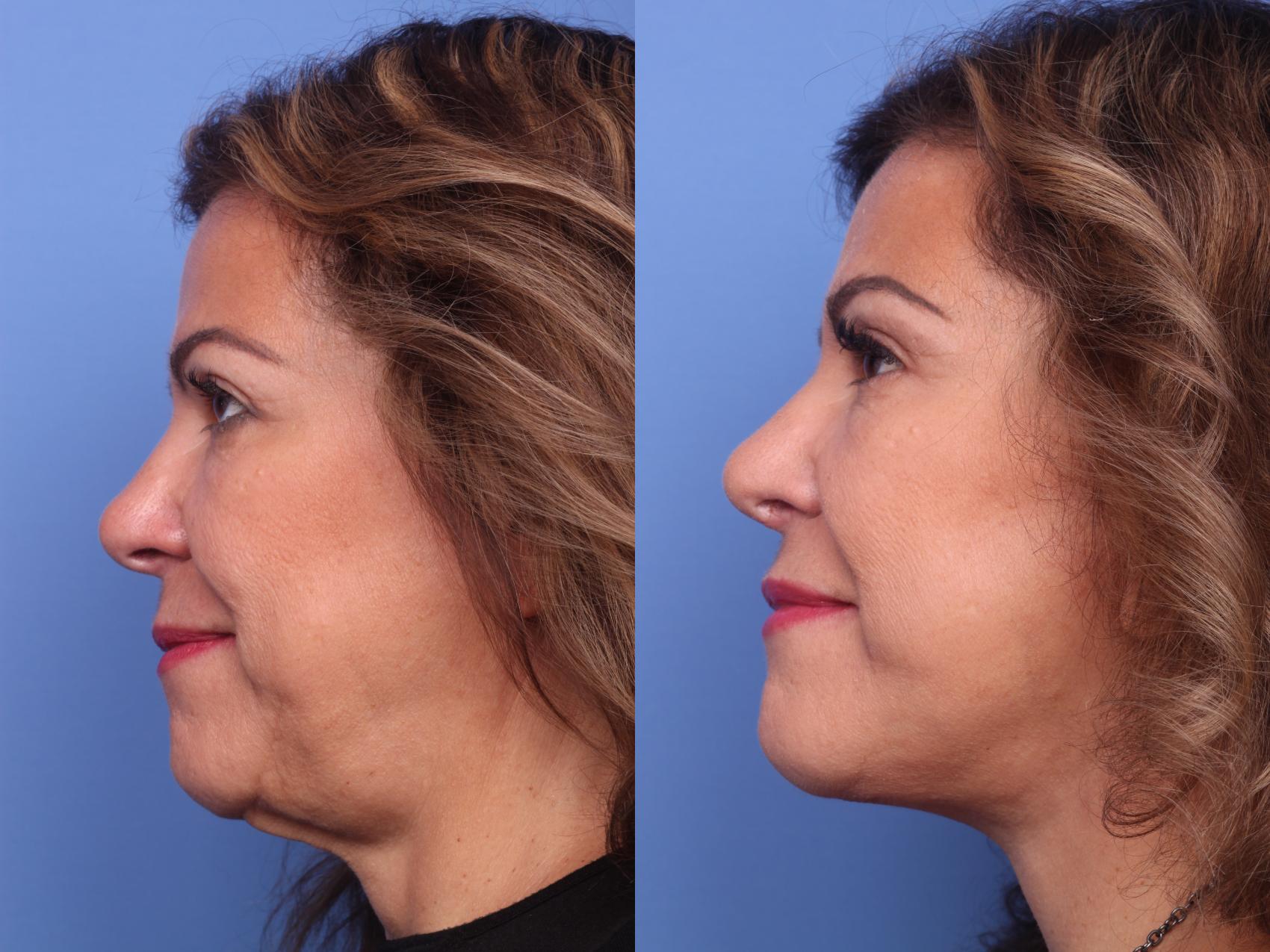 Before & After Facelift Case 149 View #2 View in Scottsdale, AZ