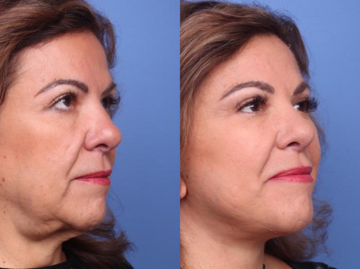 Facelift Before & After Photo | Scottsdale, AZ | Hobgood Facial Plastic Surgery: Todd Hobgood, MD