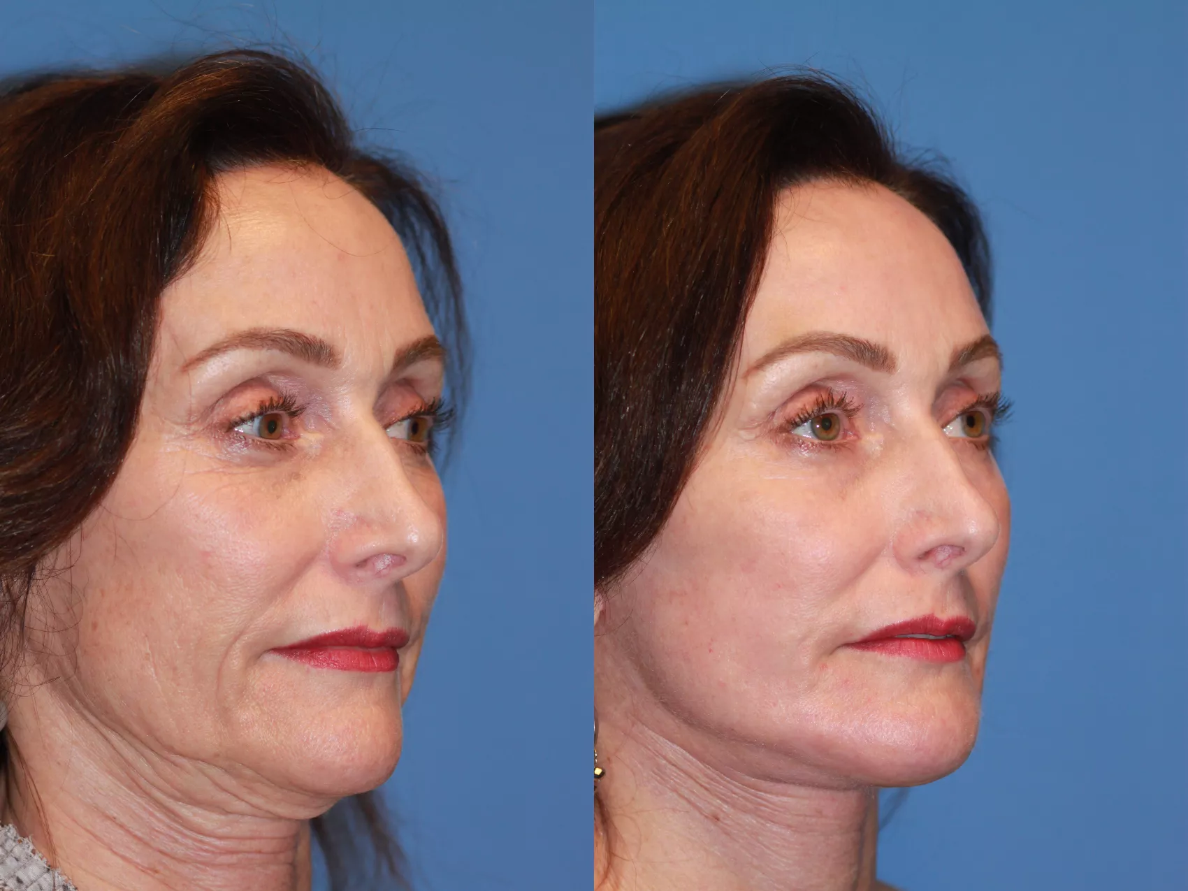 facelift-173-view-3-detail.webp