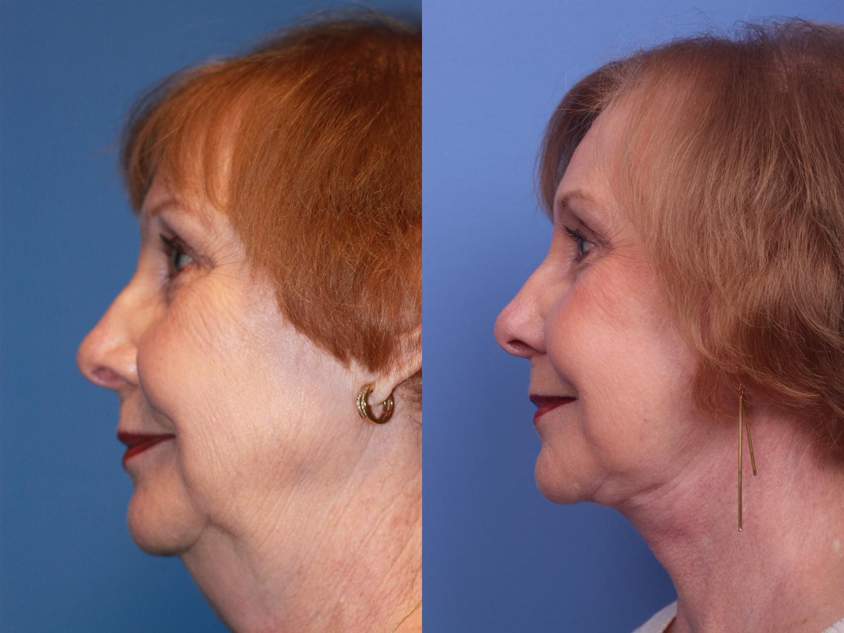 Before & After Facelift Case 181 View #2 View in Scottsdale, AZ